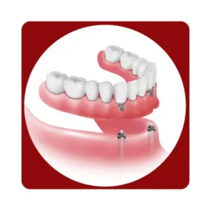Implantes Sobre dentadura total