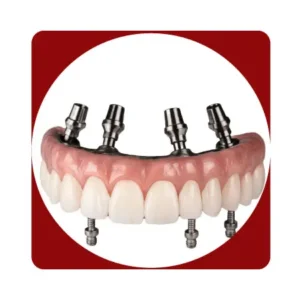 Implantes Hibridas